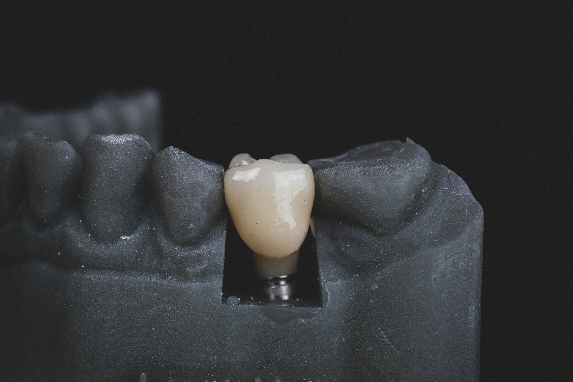 Graphic of dental implant and crown in mouth model